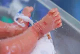 Bé trai sinh non mắc bệnh vảy cá hiếm gặp