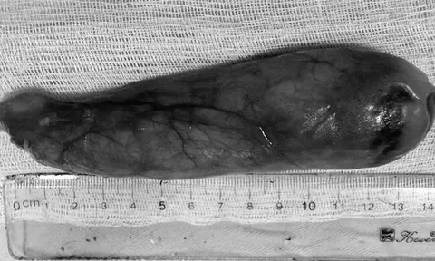 Một tháng chịu nghẹn, người phụ nữ 59 tuổi bàng hoàng khi biết thứ "đáng sợ" nằm trong cổ họng