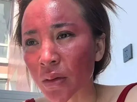 Không tẩy trang suốt 22 năm, người phụ nữ gây sốc khi mặt bị biến dạng