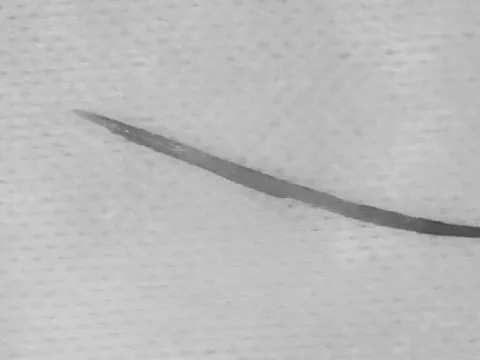 Người đàn ông 57 tuổi đau bụng thốc ngược lên, bác sĩ gắp ra thứ "đáng sợ" dài 5cm