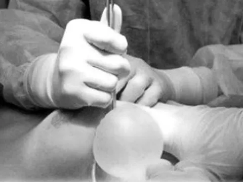 Người phụ nữ 30 tuổi bị hoại tử ngực vì tiêm chất làm đầy