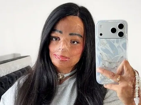 Dầu gội đầu bắt lửa, cô gái xinh đẹp bị bỏng nửa người và cái kết bất ngờ