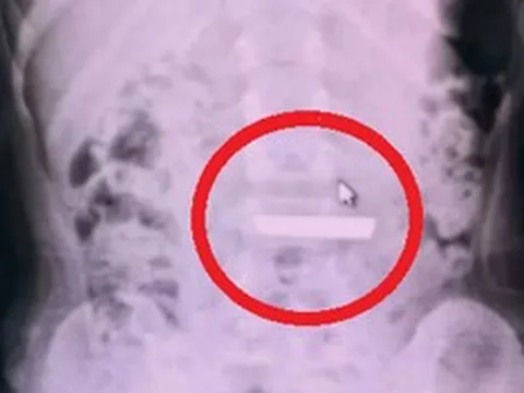 Bất ngờ phát hiện thỏi vàng trong bụng bé gái 5 tuổi